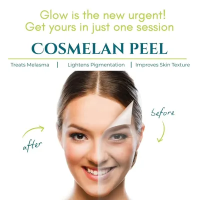 The Cosmelan Peel is one of my go-to treatments for effectively lightening pigmentation and treating melasma. This graphic shows how it works to reveal a brighter, more even complexion in just one session.