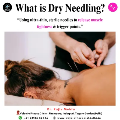 This image shows the application of Dry Needling, a technique where I use ultra-thin, sterile needles to target and release deep muscle tightness and trigger points, providing significant pain relief.