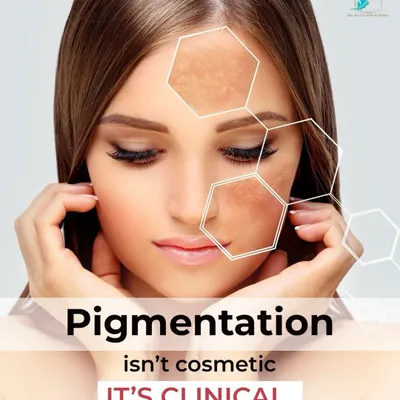 Pigmentation isn't just a cosmetic concern; it's a clinical one. Lasting clarity requires treating the cause, such as UV exposure or hormonal triggers, not just masking the color with surface-level products.