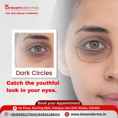 Dark circles can make you look perpetually tired. We help you catch the youthful look in your eyes again with advanced, tailored treatments designed to lighten pigmentation and restore freshness to the under-eye area.