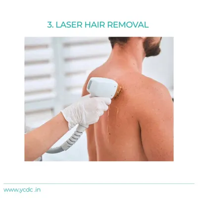 A technician performs a laser hair removal session on a male client's back. This is a popular treatment for achieving smooth skin and reducing the irritation and ingrown hairs often caused by shaving.