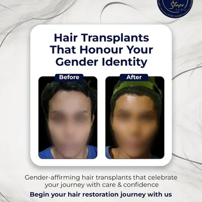 We provide gender-affirming hair transplants that celebrate your journey with care and confidence. This procedure helps align your hairline with your identity.