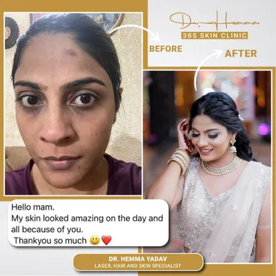 This is why I do what I do. This client came to me wanting to look her absolute best for her wedding day. We worked on a personalized plan to address pigmentation and uneven skin tone, and the results speak for themselves. Seeing her feel this confident and happy on her special day is my greatest reward.