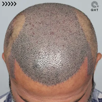 This patient came to us for a corrective hair transplant. We used 5500 grafts to recreate his hairline and re-densify the frontal part, mid-scalp, and crown.