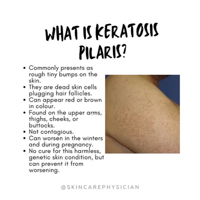 Keratosis Pilaris, often called 'chicken skin' or 'strawberry skin', presents as tiny, rough bumps on the upper arms, thighs, or cheeks. It's caused by dead skin cells plugging hair follicles.