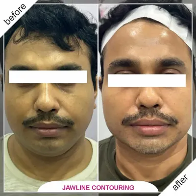 A defined jawline can significantly enhance facial harmony. This before and after showcases the results of non-surgical jawline contouring, creating a stronger, more sculpted, and confident profile for my male client.