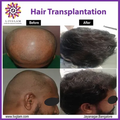 A life changing hair transplant result. This client went from significant baldness to a full, dense head of hair, completely restoring his hairline and confidence.