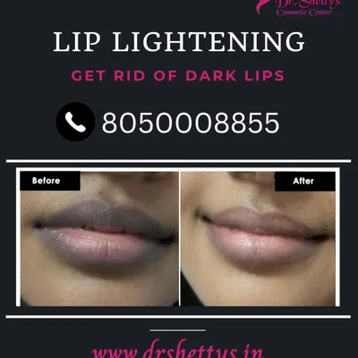 A direct comparison showing the effectiveness of our lip lightening treatment. The procedure uses targeted laser energy to safely break down excess melanin, correcting dark lip pigmentation for a natural and even tone.