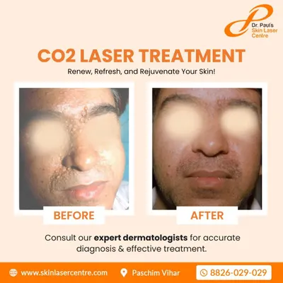A powerful demonstration of CO2 laser treatment for removing numerous facial growths. The procedure provides a dramatic improvement in skin smoothness and clarity, renewing the patient's complexion.