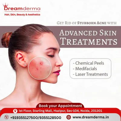 We tackle stubborn acne with a multi-pronged approach. Our advanced skin treatments include chemical peels for deep exfoliation, medifacials for healing hydration, and laser treatments to effectively target acne-causing bacteria and reduce scarring.