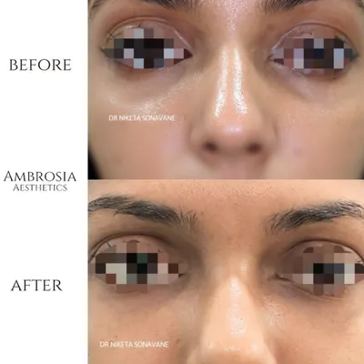 A clear before-and-after of our under-eye filler treatment. By carefully restoring lost volume in the tear trough area, we can instantly reduce the appearance of dark circles and hollowness.