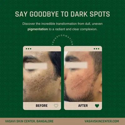 This image shows the significant reduction of deep acne scars and pigmentation on a patient's cheek after a personalized treatment plan. The 'after' photo reveals a much smoother skin texture and a more even skin tone, restoring clarity and confidence.