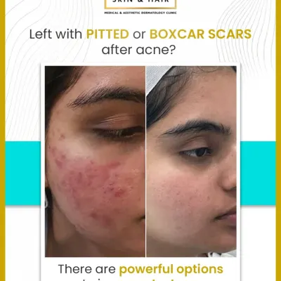 A powerful before-and-after example of how my customized treatment plans can significantly reduce the appearance of deep, pitted acne scars and restore skin confidence.