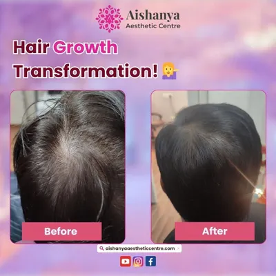 A fantastic hair growth transformation for one of my patients. Notice the significant increase in hair volume and scalp coverage after completing a personalized hair restoration plan at my clinic.