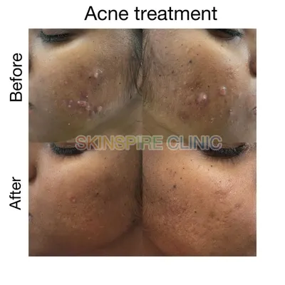 This before and after shows the result of a targeted acne treatment plan. Our first goal is always to reduce active flare-ups and prevent new ones from forming, which you can see in the clearer, calmer skin on the right.