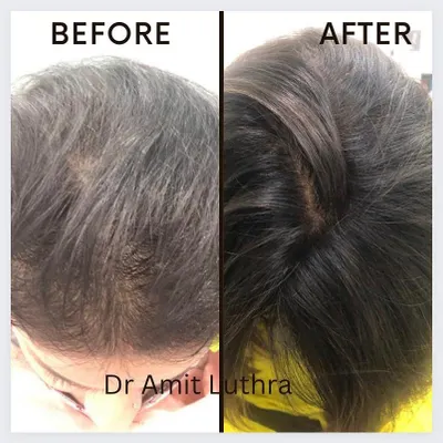 An amazing before and after result for hair fall treatment at my clinic. We use a combination of advanced techniques to achieve significant improvements in hair density and health.