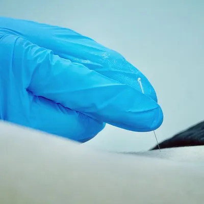 Dry needling is a precise technique we use to target and release tight muscle knots, or trigger points. A gloved therapist carefully inserts a fine needle to alleviate chronic pain and restore muscle function.