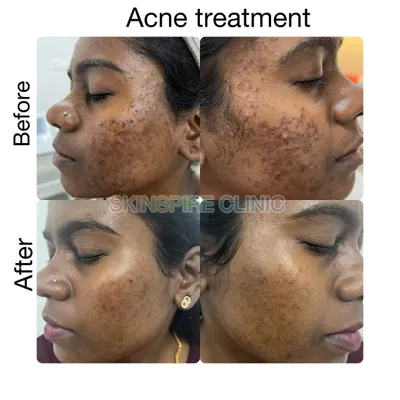 This before and after collage shows a significant reduction in active acne and post-inflammatory hyperpigmentation. Our treatment plan is designed to clear existing acne and prevent future breakouts for long term results.