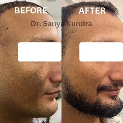 A remarkable before and after of a client's journey with us. This image shows a significant reduction in acne scars and improved skin texture after undergoing treatments like microneedling and PRP.