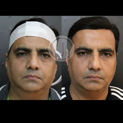 This patient's result was achieved by combining two powerful treatments. First, we used HIFU to stimulate collagen, and then we used PDO threads for an added lift. This combination approach provides a more comprehensive and longer-lasting skin tightening effect.