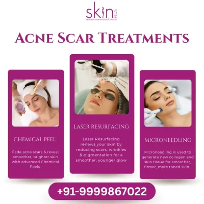 This graphic showcases my primary treatments for acne scars: Chemical Peels for revealing smoother skin, Laser Resurfacing for renewing skin, and Microneedling for generating new collagen and tissue.