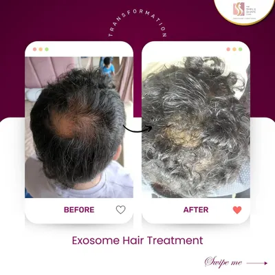 This is the kind of transformation that makes my work so rewarding. Using a science-backed Exosome treatment plan, we were able to significantly improve hair density and coverage for this client, addressing the thinning at the crown and restoring his confidence.