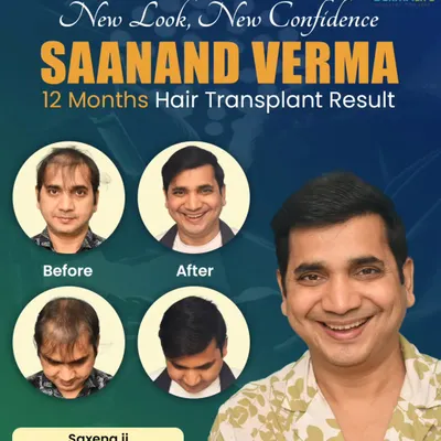 Here is the 12-month result for Saanand Verma, popularly known as Saxena Ji. We focused on creating a dense and age-appropriate hairline that completely revitalized his look.