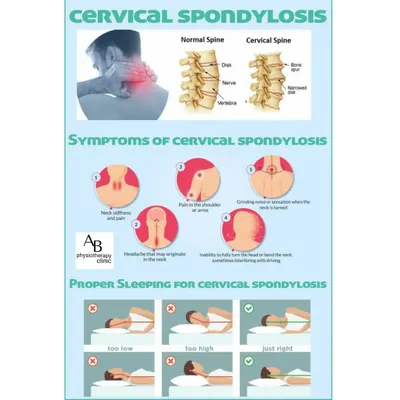 Cervical Spondylosis, or arthritis of the neck, is a common age-related condition. This guide explains its symptoms, like neck stiffness and grinding sensations, and shows the correct sleeping posture to help manage pain.