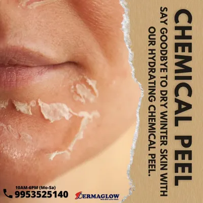 This image shows the exfoliation process that occurs after a chemical peel. This shedding of the outer, damaged layer of skin is a natural part of the renewal process, revealing the fresh, smooth, and hydrated skin underneath.