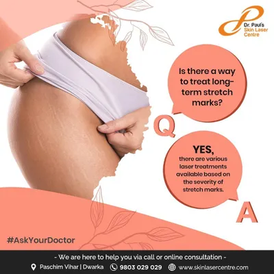 Patients often ask if long term stretch marks can be treated. Yes, various laser treatments are available, and I select the best option, such as the CO2 fractional laser, based on the severity of the marks.