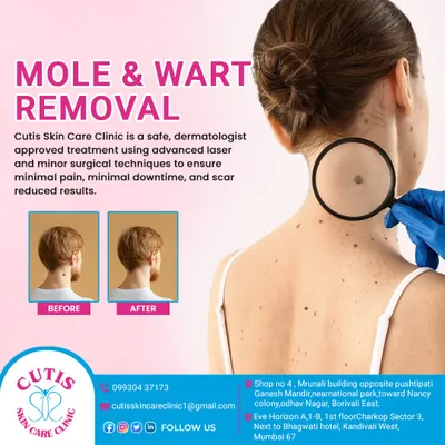 This graphic explains our safe, dermatologist-approved treatments for mole and wart removal. We use advanced laser and minor surgical techniques to ensure minimal pain, minimal downtime, and scar-reduced results, as shown in the before and after example.