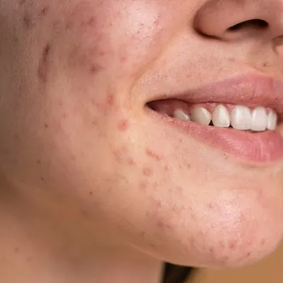 This image shows common atrophic acne scars, which are depressions left after severe acne. My treatment for such scars focuses on rebuilding collagen from within using procedures like microneedling or fractional lasers to gradually improve skin texture and smoothness.