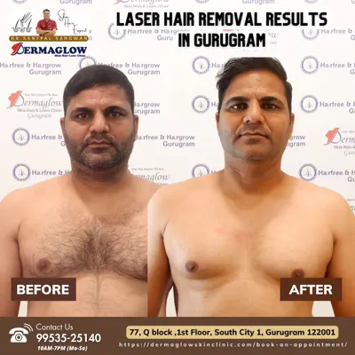 This client achieved a completely smooth chest after undergoing our full laser hair removal course. The comparison clearly demonstrates the permanent elimination of unwanted hair, moving from dense growth to clear skin.