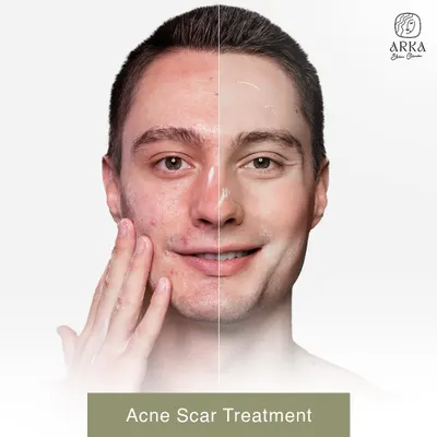 This before-and-after shows a significant reduction in active acne and inflammation. My approach focuses on treating the root cause, whether it's hormonal, diet-related, or stress-induced, to provide long-term relief.