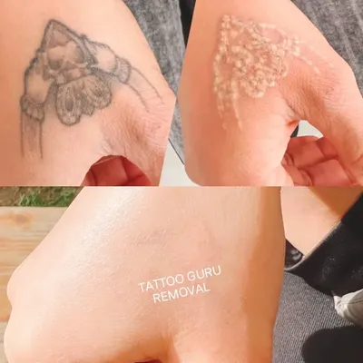 This collage is a great summary of the removal process on a hand tattoo. It shows the original design, the immediate white 'frosting' post-laser, and the final clear skin after the full treatment and healing period.