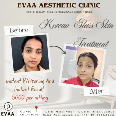 A real client's before-and-after results from our Korean Glass Skin Treatment, demonstrating instant whitening and a dramatic improvement in skin clarity and glow.