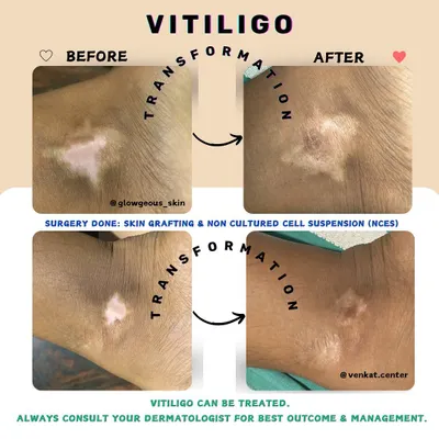 This before-and-after image shows the transformative results of vitiligo treatment. Using a combination of skin grafting and non-cultured cell suspension (NCES), we were able to successfully restore pigment to the affected area. Vitiligo is treatable, and a consultation with a dermatologist is the first step.