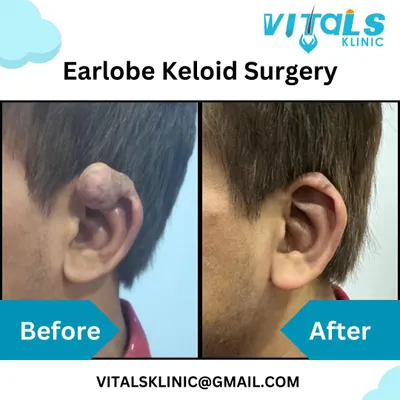 This powerful before-and-after shows the result of an earlobe keloid surgery. The procedure involved careful surgical removal of the excessive scar tissue to completely restore the ear's natural shape.