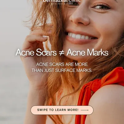 It's important to know that acne scars are not the same as acne marks. Scars involve damage to the deeper layers of the skin and require specific treatments to improve.