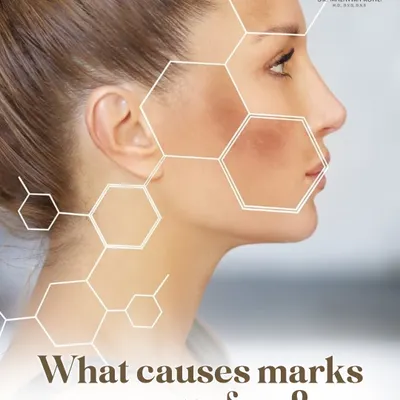 Facial marks and discoloration can stem from a variety of underlying conditions. Understanding the specific cause, whether it is post-inflammatory hyperpigmentation, melasma, or another issue, is the first step toward creating an effective treatment plan.