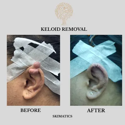 This before and after image shows a successful keloid removal from the ear. Keloids are raised scars that can form after minor skin trauma. We use specialized techniques to remove the scar tissue and help restore a smoother skin surface.