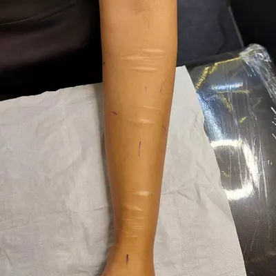 Before: This image shows the client's forearm with visible self-harm scars before the cover-up process.