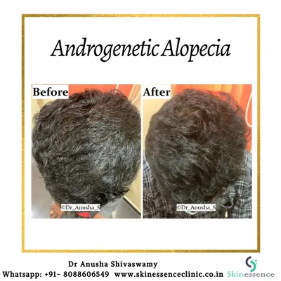 This top-down view clearly shows the successful treatment of androgenetic alopecia. The patient's hair appears significantly fuller and the scalp is less visible after a course of customized medical therapy.