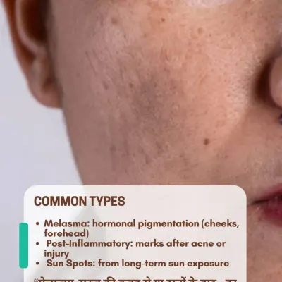 Pigmentation comes in many forms. It can be hormonal melasma, post-inflammatory marks left after acne, or sun spots from long-term sun exposure. Understanding the cause is key to effective treatment.