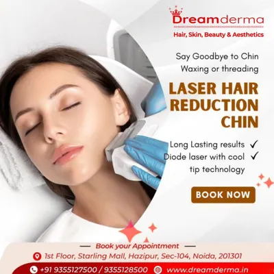 This image shows a laser hair reduction session for the chin area. I use a precise applicator to target unwanted facial hair, offering a long lasting solution with Diode laser technology that includes a cool tip for your comfort.