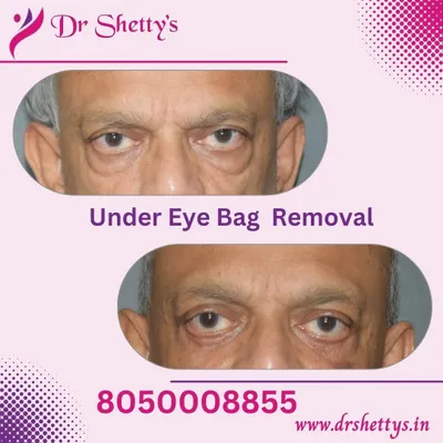 This image shows the direct before and after results for a patient who underwent under-eye bag removal. Notice the significant reduction in puffiness and the smoother transition from the lower eyelid to the cheek.