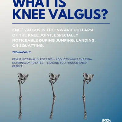 This infographic explains Knee Valgus, the inward collapse of the knee, which is a major risk factor for ACL injuries. I assess every athlete for this and other movement faults to correct the pattern before it causes a problem.