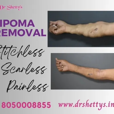A clear before and after comparison of a patient's arm with multiple lipomas. The 'after' photo shows a smooth arm with no visible scars, demonstrating the effectiveness of our stitch-less and scarless removal technique.