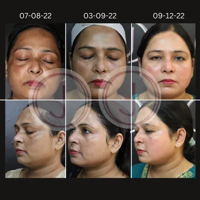 This series shows a patient's progress over five months in treating significant hyperpigmentation. With consistent, steroid-free depigmenting peels and laser sessions, we achieved a remarkable improvement in skin clarity and tone.
