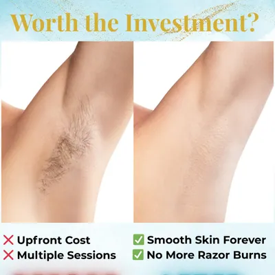 Is laser hair removal worth the investment? This before-and-after of an underarm treatment clearly shows the result: permanently smooth skin with no more razor burns or stubble.